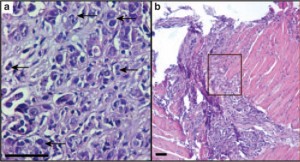 Stained sections of (a) control and (b) IL-25–treated tumors with higher-magnification image of the boxed region in (b). Control sample shows actively growing tumor cells [arrows], whereas in the IL-25–treated sample, the tumor was completely regressed. (Image courtesy of Saori Furuta)