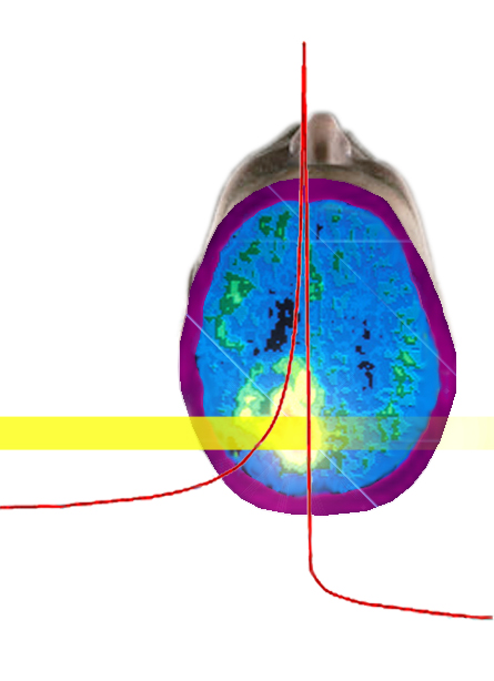 A beam of carbon ions penetrates deeply before depositing most of its energy at a specific depth in tissue, as indicated by the red curve (the Bragg peak). PET scans take too long to give a picture of whether the beam accurately hit the tumor. But since gamma rays are emitted instantly when the beam interacts with nuclei in tissue, they could indicate the precise location and dose while there’s still time to adjust the treatment.