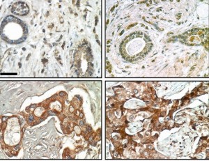 Immunohistochemical analysis of FAM83A expression in normal (top) and malignant (bottom) breast tissue specimens shows that whereas 0 of 16 normal cells were strongly positive for FAM83A staining, 45 of 48 malignant cells were positive. 