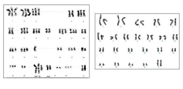  The left image shows the chromosomes of an immortal cell line derived by treatment with a chemical carcinogen. It has an aberrant number and arrangement of chromosomes. This line had to generate the errors that allowed immortalization. The right image shows the chromosomes of an immortal line derived using the new Berkeley Lab method. It has the normal number of 46 chromosomes arranged in 23 pairs. Because of their normal karyotype, these new immortal cell lines may help scientists better understand cell immortalization as it occurs in people. (Image credit: Arthur Brothman and Laura Fuchs, left image; Karen Swisshelm, right image).