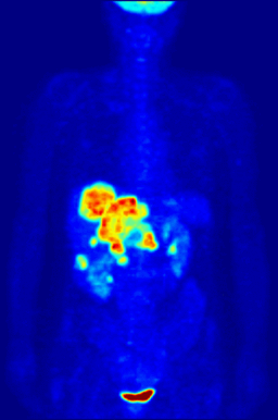 Animation - This animation shows a 3-D rendering of a whole-body positron emission tomography (PET) scan showing the location of a cancerous tumor (abdominal region). The tumor imaging was made possible by fludeoxyglucose, a chemical compound containing a radioactive form of fluorine known as fluorine-18. (Credit: Jens Maus/Wikimedia Commons)