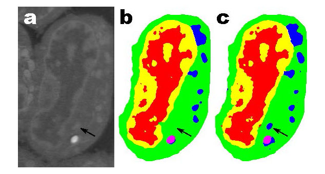 Slice of mouse llymphoblastoid cells. Raw data (a): corresponding manual segmentation (b) and output of an MS-D network with 100 layers (Data from A.Ekman, C. Larabell, National Center for X-ray Tomography)