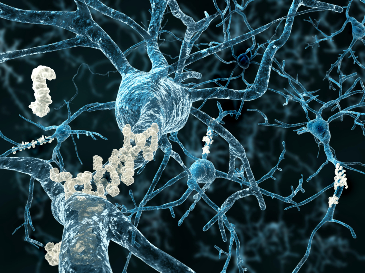 Alzheimer's plaques on neurons
