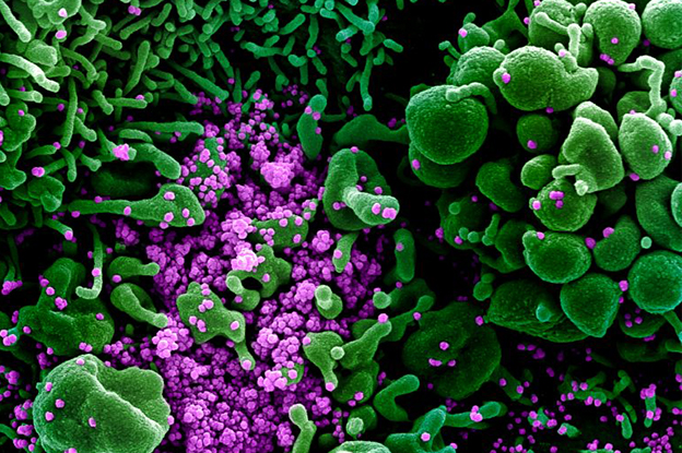 This color-enhanced image, taken by scanning electron microscopy, shows huge quantities of SARS-CoV-2 particles (purple) that have burst out of kidney cells (green), which the virus hijacked for replication. The bulging, spherical cells in the upper-right and bottom-left corners are distorted and about to burst from the viral particles inside, and are beginning to self-destruct. (Credit: NIAID Integrated Research Facility)