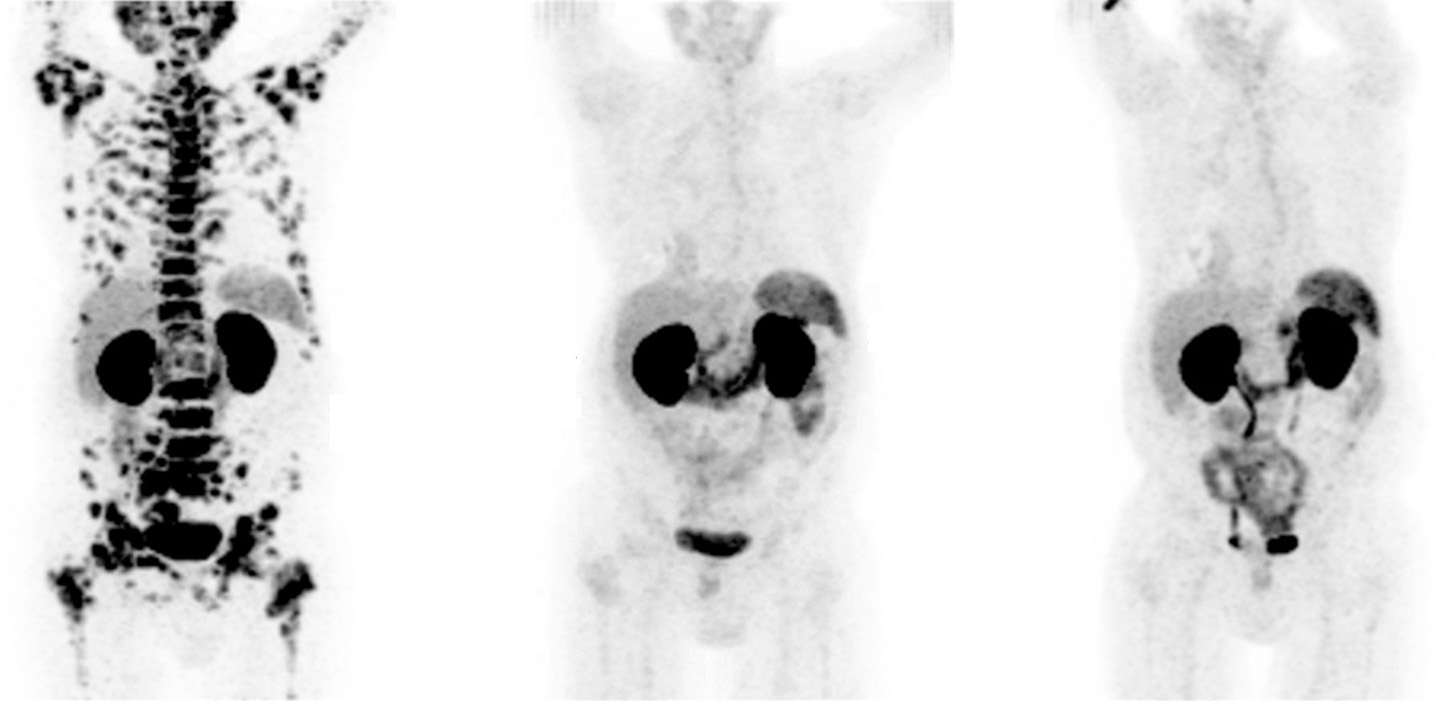 Three black and white images of a person's body. The first is scattered with spots throughout the body. The second and third scans have almost no black spots.